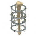 Спице-кольцевые аппараты по Г.А. Илизарову