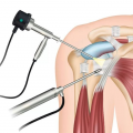 Артроскопия плечевого сустава